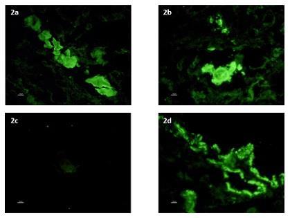 Immunofluorescence images of renal biopsy 2a: Tubular casts highlighted with FITC-IgG (3+) (20x) 2b: Tubular casts highlighted with FITC-Lambda (3+)
