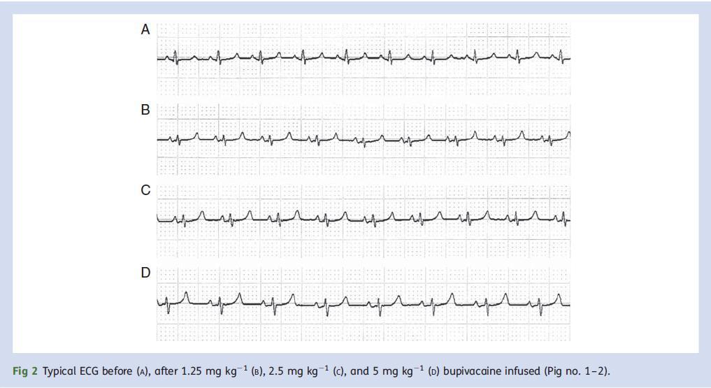 T-wave elevation caused by bupivacaine