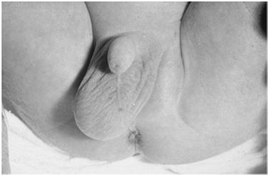 again After puberty, the increased size of the testicle prevents retraction Usually bilateral and most common in