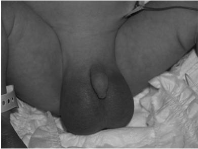 The Acute Scrotum (Testicular Torsion) Epididymitis
