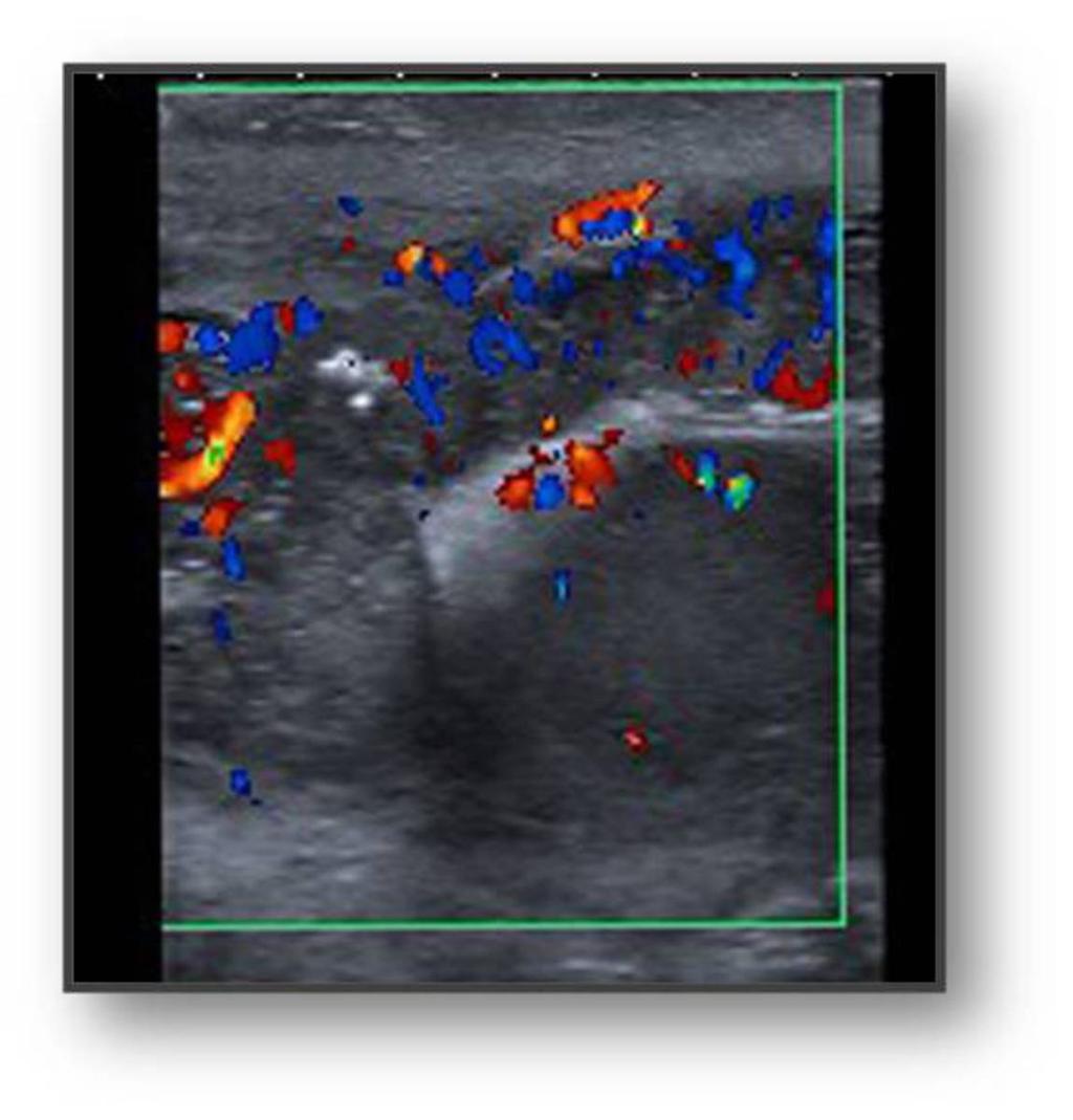 Fig. 8: Right epididymis thickened, diffusely