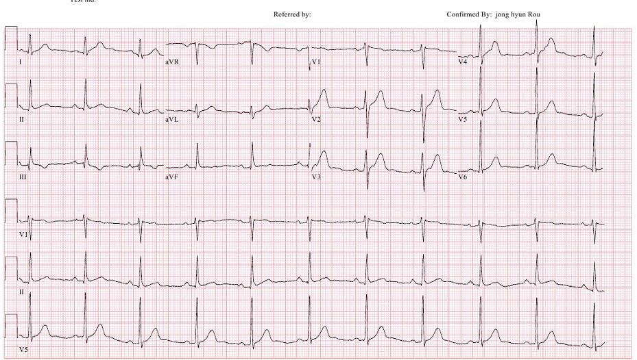 42, M CAG: Mild stenosis in p-rca (30%) EPS: Ventricular extrastimuli induced regular narrow QRS tachycardia,