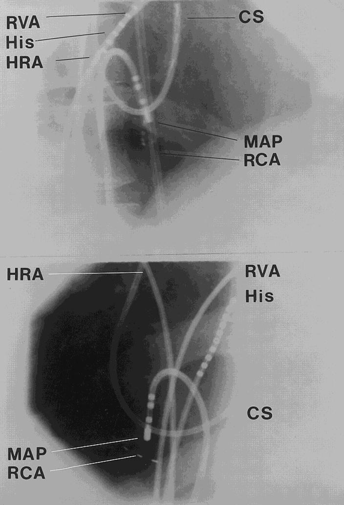 Left, Fluoroscopic views (top panel, 30 right anterior oblique; bottom panel, 30 left anterior oblique) illustrate right coronary artery (RCA) mapping to guide positioning of the