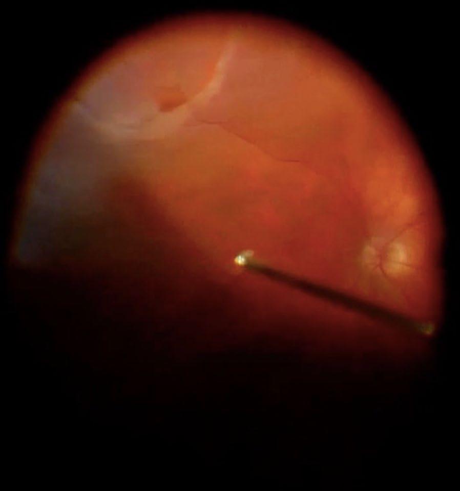 Page 2 of 6 Technological advancements allow the surgeon to visualize all retinal breaks, as well as the removal of opacities. On the other hand, Afrashi et al.
