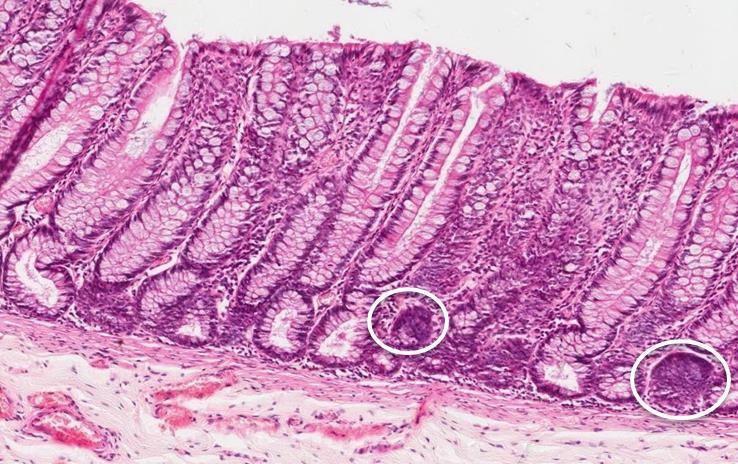 1- Mucosa (Shows only crypts) : Epithelium lining