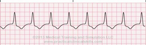 Early beats are wide and bizzare with no P wave - PVC 57 58 Idioventricular