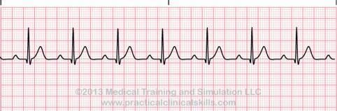 First Degree AV Block Dependent on underlying rhythm/rate Second Degree AV Block Type 1 Overall irregular Overall irregular Consistent in morphology, P wave for every QRS and consistent, measures <0.