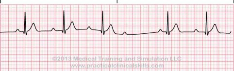 12 but irregular Progressively increases until a QRS is dropped Monitor for increasing block 67 NSR with 1 st Degree AV Block Rate=70 QRS=.06 PR=0.
