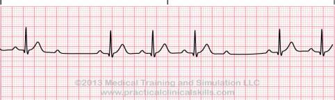 38 Dropped Repeating Cycle QRS Longer, longer, drop, then you have Wenkebach Second Degree AV Block Type 2 Irregular due to blocked beats Consistent shape/morphology, some P s without a QRS
