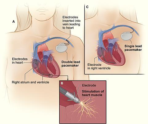Types of Pacemakers - Temporary Transcutaneous Delivers electrical impulses through adhesive patches; usually from a defibrillator (i.e. Zoll) Short-term use only Transvenous Often used as bridge to