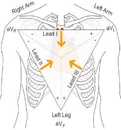 (+) (Right Left, or lateral) Lead II: RA (-) to LL (+) (Superior Inferior) Lead III: LA (-) to LL (+) (Superior Inferior) Augmented unipolar limb leads (frontal plane: Lead avr: RA (+) to [LA & LL]
