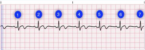 Atrial: Normal 60-100 () Ventricular: Normal 60-100 (QRS complexes) Morphology, consistency, frequency QRS