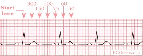 Measuring Heart Rate 300 rule Pick a QRS complex that falls on a heavy line Use 300 rule to count to next complex 300, 150, 100, 75, 60, 50, 40, 30 Measuring Heart Rate ECG ruler