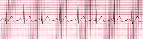 png 38 Rhythm Analysis Normal Sinus Rhythm is the atrial rate (P to P) regular and WNL (60-100) Ventricular rate is the ventricular rate (R to R) regular and WNL?