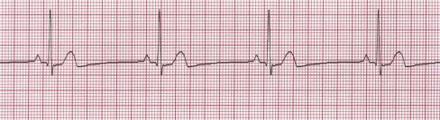 ity Ventricular Rate QRS Nursing Implications ; P to P regular with rate 60-100 bpm ; R to R regular with rate 60-100 bpm Consistent in morphology, P wave for every QRS and consistent,