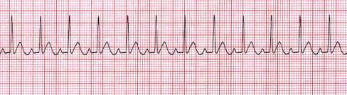 20 seconds Ensure stable hemodynamics (pulse, BP) 39 40 Sinus Bradycardia Sinus Tachycardia ity ity ; P to P regular with rate <60 bpm ; P to P regular with rate 101-150 bpm Ventricular