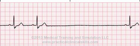 18 Monitor for increased irregularity NSR Focus on the UNDERLYING rhythm first, then the extra beats!