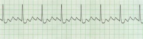 Atrial Flutter A Flutter with 4:1 conduction A Flutter with 2:1 conduction