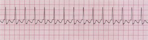 the SA node Ventricular Rate 150-250 Too fast to see if they are present QRS