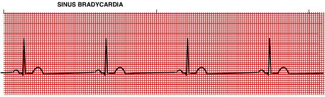Sinus Bradycardia Less than 60 BPM What is the atrial rate? Ventricular rate? Are there P waves present?