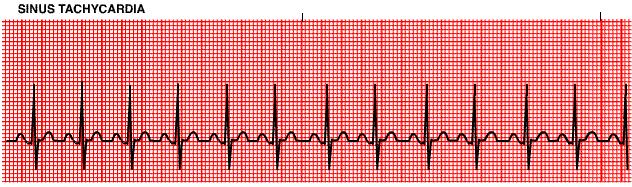 Sinus Tachycardia 101 to 150 BPM What is the atrial rate? Ventricular rate?