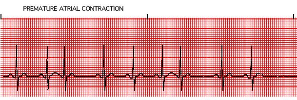 Premature Atrial Contraction (PAC) PAC s originate from any atrial site outside of the SA node NOTE: Although the