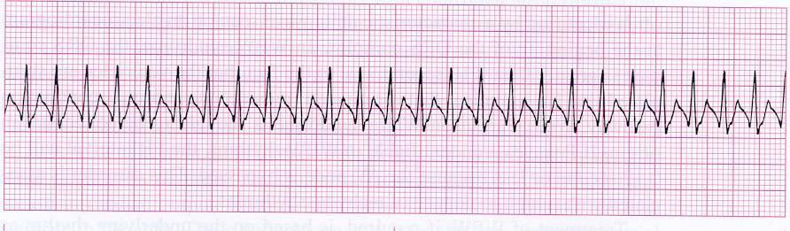 Supraventricular Tachycardia (SVT) Greater than 150 BPM Can you identify P