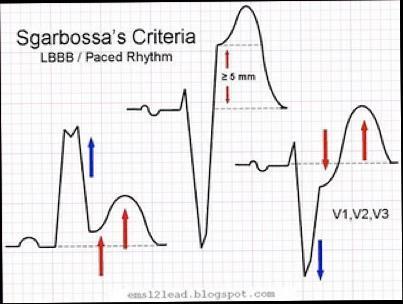 Sgarbossa Criteria Discordance: Opposite deflections of the QRS and ST segment