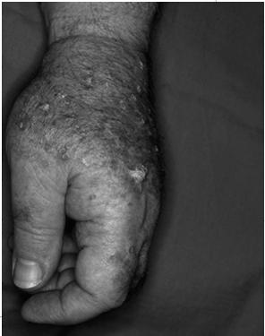 Actinic Keratosis In-situ dysplasia from ultraviolet exposure. Sign of sufficient sun injury to develop NMSC. Precancerous (low rate <1%) Prevented by sun screen use, even in adults.
