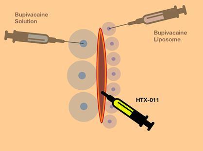 Although it Can Be Injected Like Bupivacaine, HTX-011 is Ideally Suited for Needle-Free Administration HTX-011 is easy to apply and stays in place at the surgical site after application HTX-011