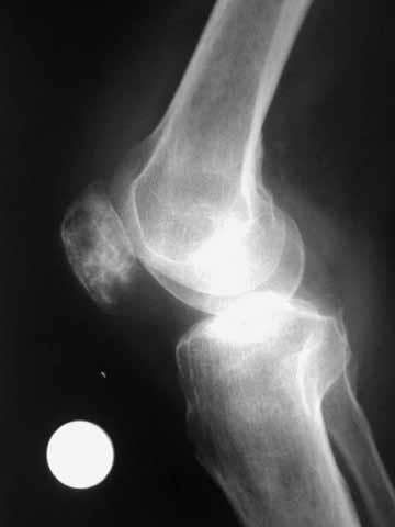 TUMOURS AND TUMOUR-LIKE LESIONS OF THE PATELLA 393 Fig. 2. MRI showing a hypointense lesion in a patient with patellar metastasis from rectal adenocarcinoma. Fig. 1.