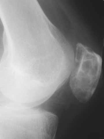 394 Y. SAGLIK, Y. YILDIZ, K. BASARIR, E. TEZEN, D. GÜNER Fig. 3. Radiograph of the knee in the patient with a giant cell tumour of the patella. Fig. 4.