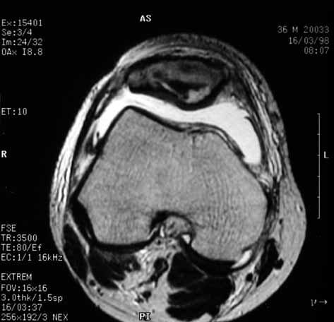The patella was involved in 8 of 3126 primary and metastatic bone tumours, with an incidence of 0.25% which is consistent with the estimate of 1 to 4 cases out of 1,000 cases of bone tumour (11).