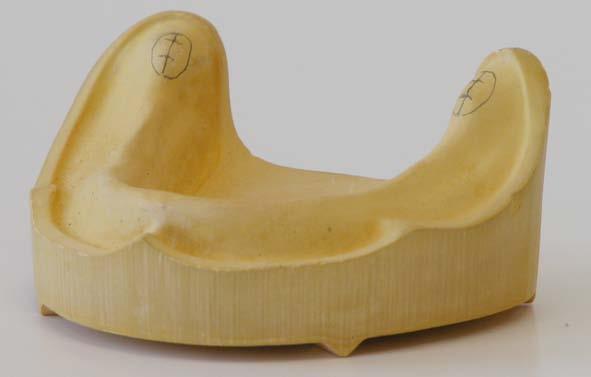 A 6.8 Average value method for the lower jaw model using the KaVo Plastering Gauge Mat. No. 0.6.7 (APF Method) The plastering gauge makes it possible for partial or fully edentulous lower jaw models to be articulated in the PROTAR articulator.