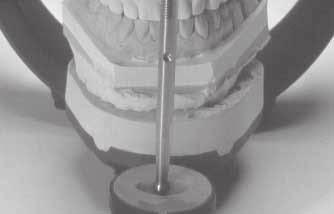 By using models before the preparation, the front incisal guidance can be transferred to the still doughy autopolymer by movements in the