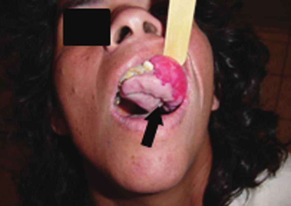 INTRODUCTION Peripheral ossifying fibroma is one of the most common inflammatory hyperplasia (excessive cell reproduction) injury affecting mouth cavity.