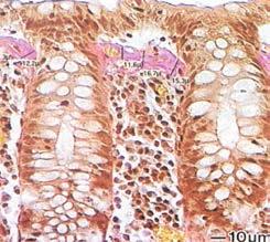 The informed patient Surface of the bowel mucosa epithelium collagen band collagen band crypts Figure 3: Schematic illustration (left) and microscopic image (right) of the bowel mucosa in collagenous