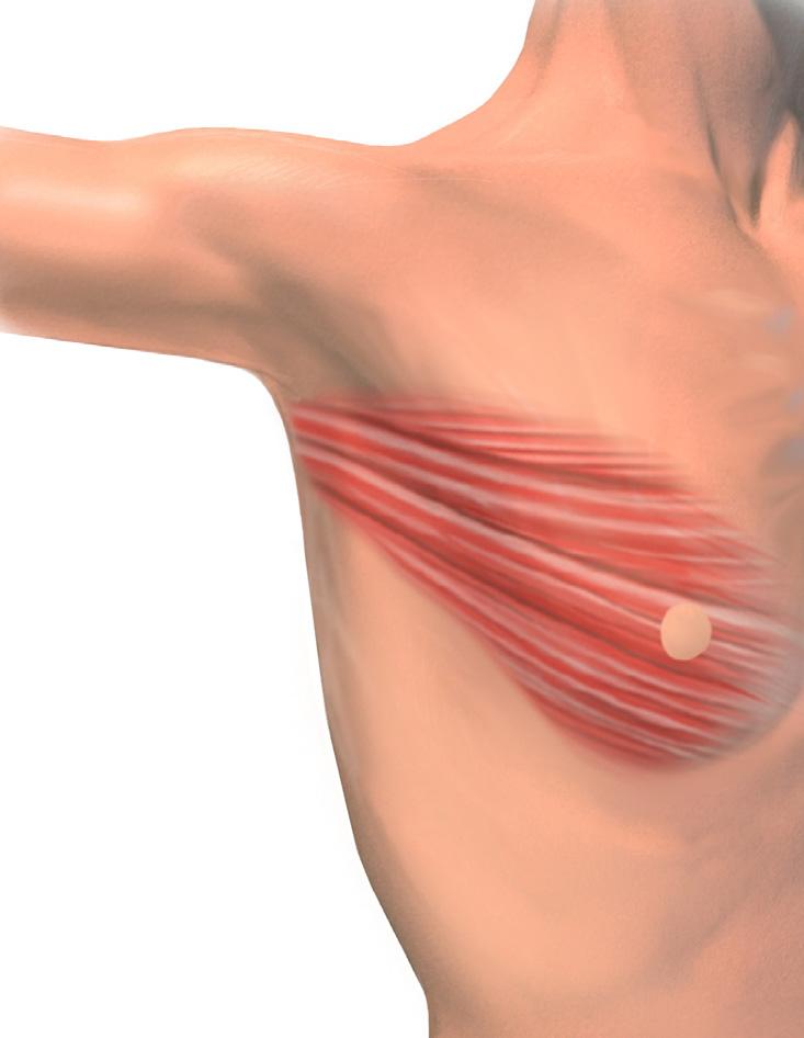 What is a breast reconstruction with latissimus dorsi flap? A breast reconstruction is an operation to recreate a breast shape after you have had a mastectomy (removing all your breast).