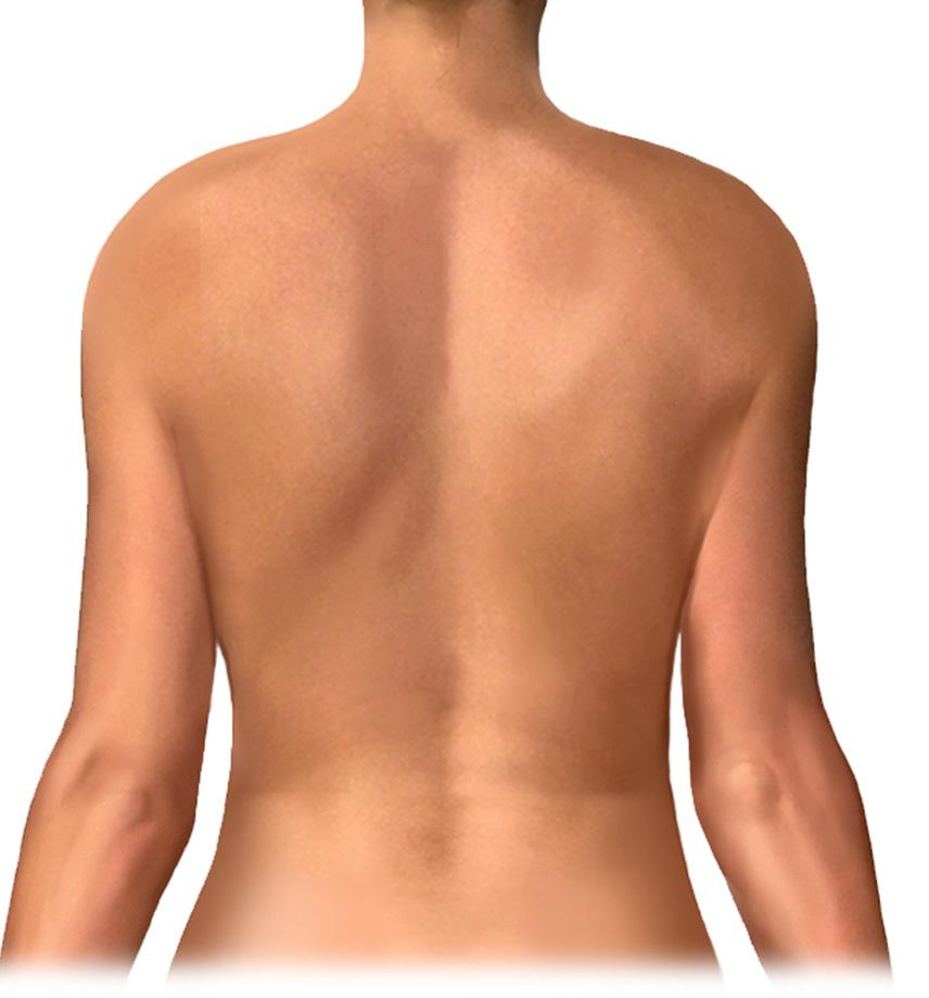 The stitches will eventually dissolve and the cuts will usually heal to neat scars (see figure 4). Figure 4 Typical position of the scar in the back What kind of breast implant should I choose?