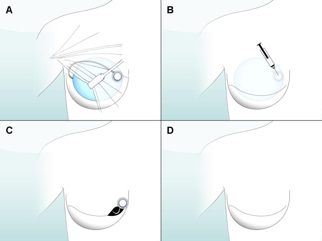 Figure 1. The single stage implant reconstruction. (A) A pocket is made in between the chest muscle (pectoralis major) and the rib.