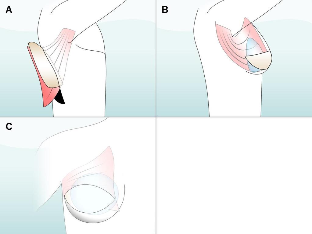 Figure 4. (A) To make the flap: muscle, skin, and fat are taken from the back.