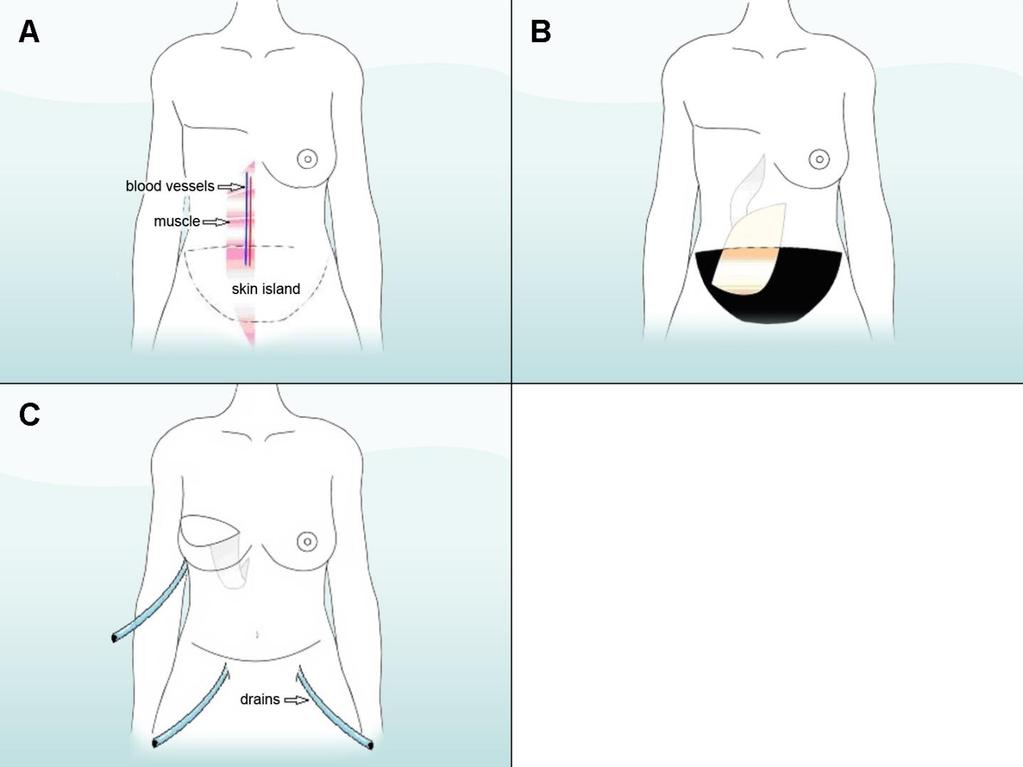 Figure 5. (A) An area of skin on the abdomen is marked off. The flap is made with the skin, fat and muscle from this area.