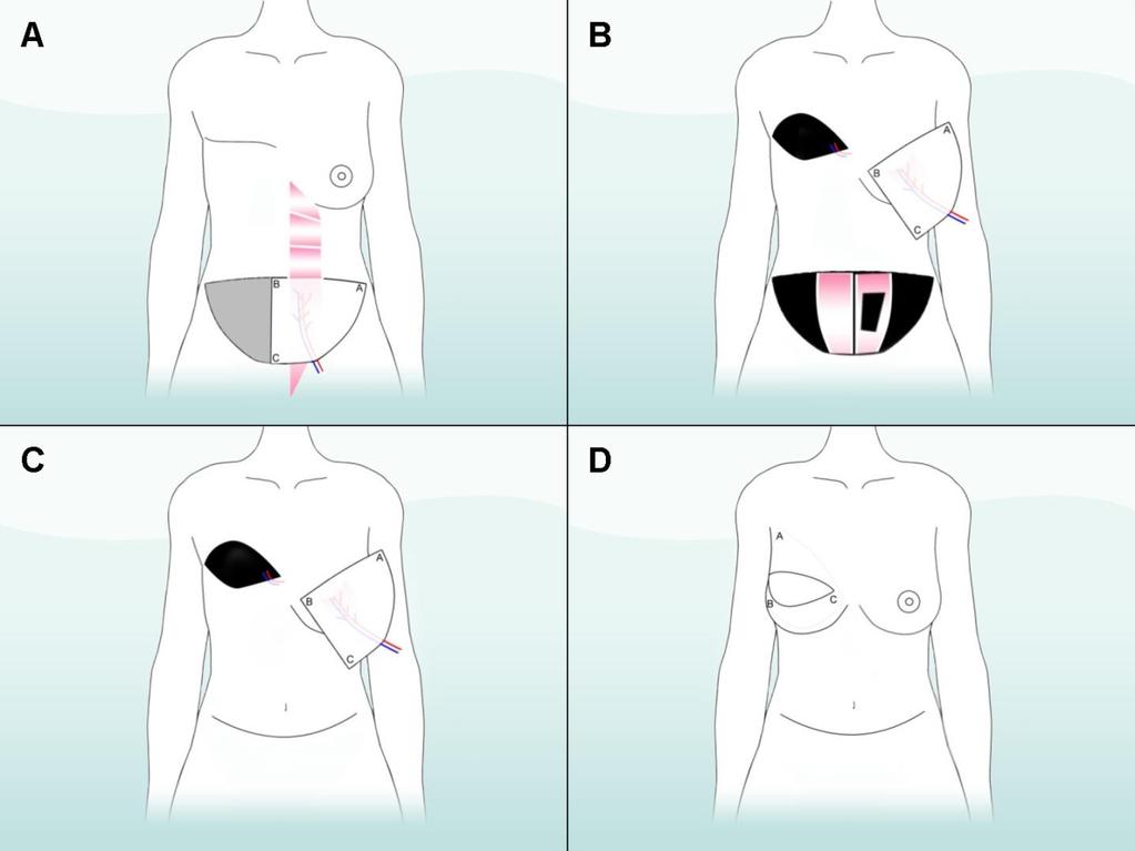 Figure 7. Free abdominal flap that is connected to blood vessels in the chest (internal mammary vessels) (A) Blood vessels that supply blood to the flap comes from the abdomen.