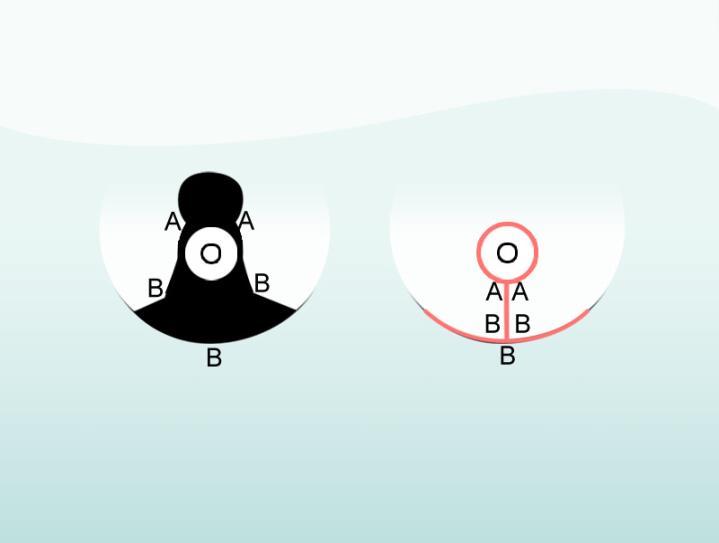 b. Breast Reduction (Balancing reduction mammoplasty) Through the same incisions as a mastopexy, skin, fat, and breast tissue are removed in order to match the size of the other breast or the size