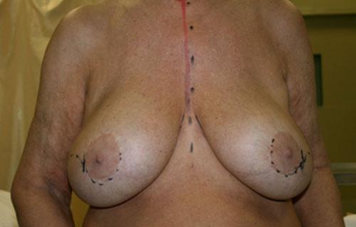 CASE REPORT A 60-year-old woman presented in 2011 with a nonpalpable 3-mm diameter mass visualized at ultrasound in the right breast close to a silicone implant imaging [Figure 1].