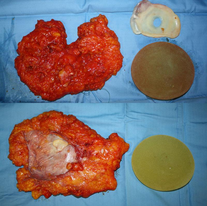 The resection specimens of both breasts showed nodular amyloid deposits only, with no evidence of cancer or calcifications [Figure 4].