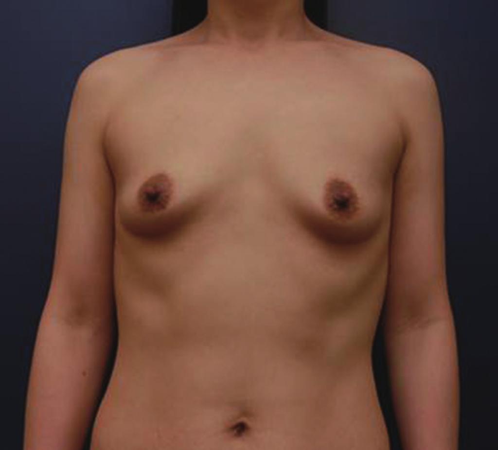Kim YJ et al. Preventing breast implant malposition Fig. 1. Preoperative and postoperative photographs of case 1 (A) Preoperative view.