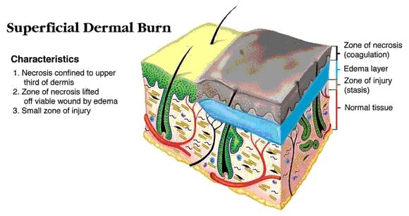 Estimating burn depth Superficial Involves only the epidermis and is characterized by erythema.