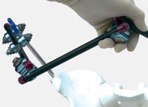 Place the second Schanz screw approximately 2 cm 3 cm posterior to the first, in the middle of the