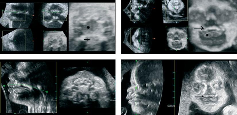 Three-dimensional ultrasound diagnosis of cleft palate 401 Figure 2 (a) Flipped-face technique, with multiplanar images on the left.